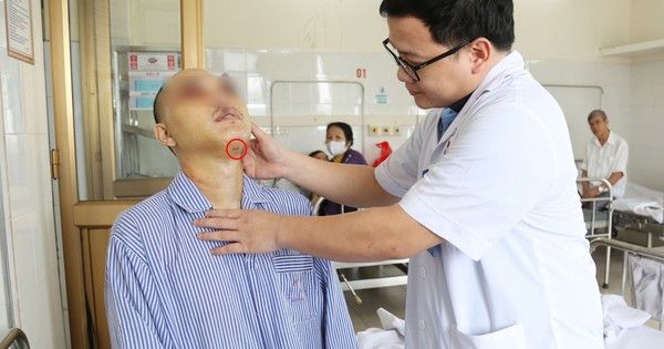 Lần đầu tiên đặt ống nội khí quản đường dưới cằm cho bệnh nhân chấn thương hàm mặt